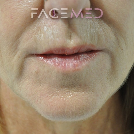 HA dermal filler + muscle relaxant lower face_10_post