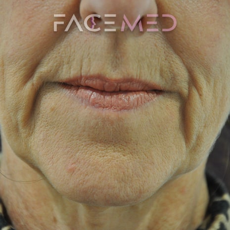 HA dermal filler + muscle relaxant lower face_10_pre
