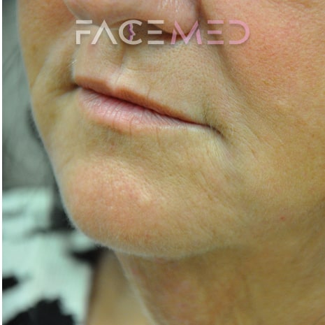 HA dermal filler + muscle relaxant lower face_11_post