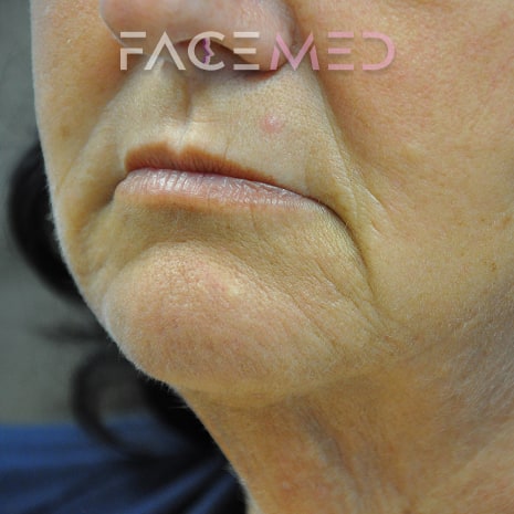 HA dermal filler + muscle relaxant lower face_11_pre