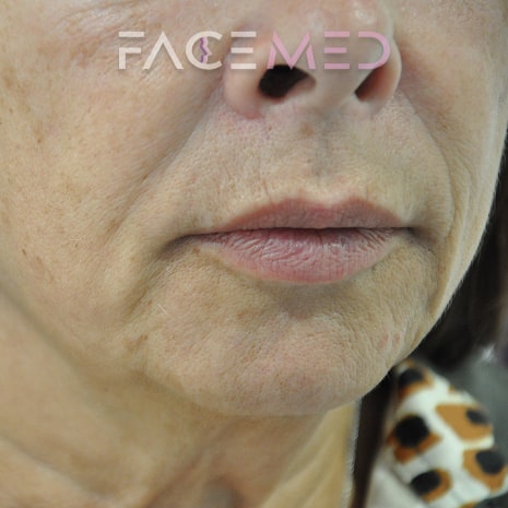 HA dermal filler + muscle relaxant lower face_12_post