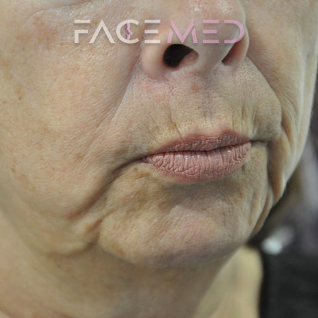 HA dermal filler + muscle relaxant lower face_12_pre