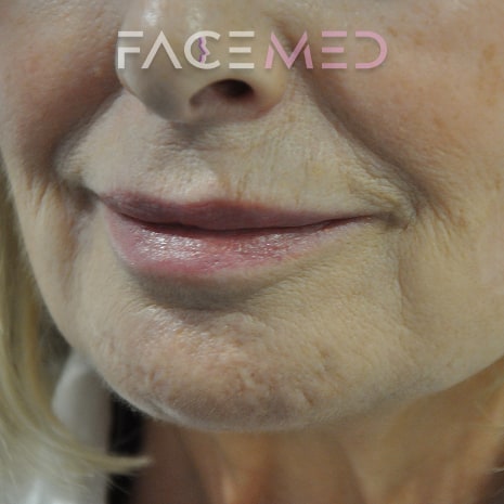 HA dermal filler + muscle relaxant lower face_13_post