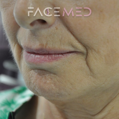 HA dermal filler + muscle relaxant lower face_13_pre