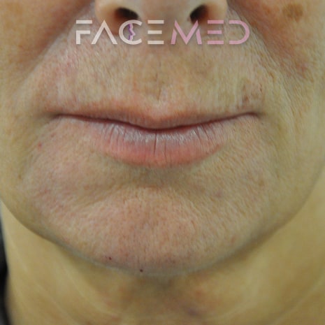 HA dermal filler + muscle relaxant lower face_14_post