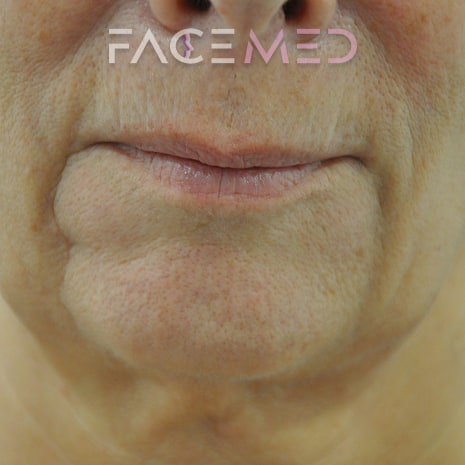 HA dermal filler + muscle relaxant lower face_14_pre
