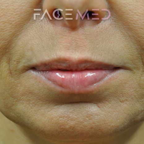 HA dermal filler + muscle relaxant lower face_15_post