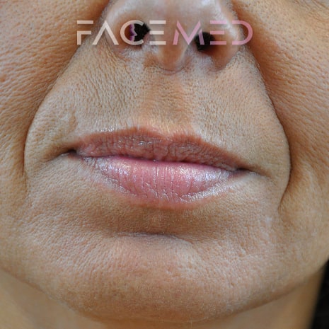 HA dermal filler + muscle relaxant lower face_15_pre