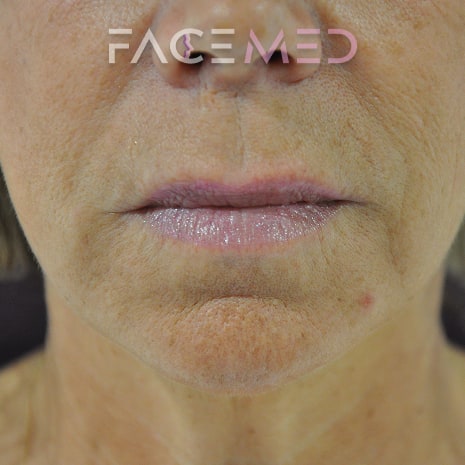 HA dermal filler + muscle relaxant lower face_17_post