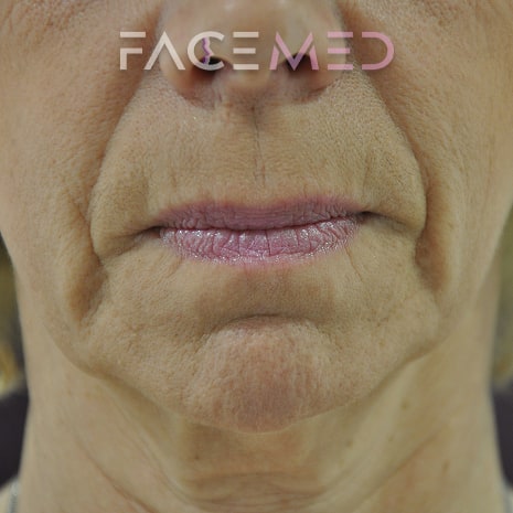 HA dermal filler + muscle relaxant lower face_17_pre