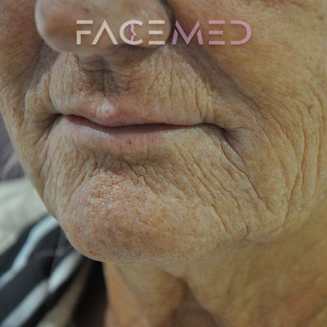 HA dermal filler + muscle relaxant lower face_18_post