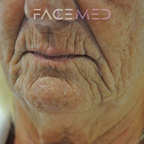 HA dermal filler + muscle relaxant lower face_18_pre