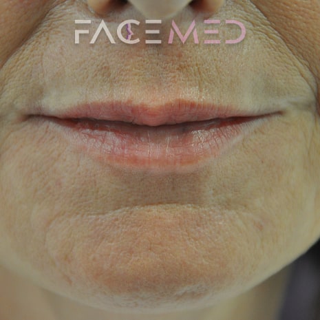 HA dermal filler + muscle relaxant lower face_19_post