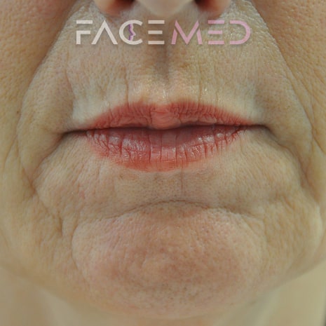 HA dermal filler + muscle relaxant lower face_19_pre