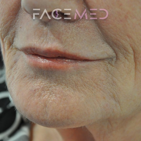 HA dermal filler + muscle relaxant lower face_1_post