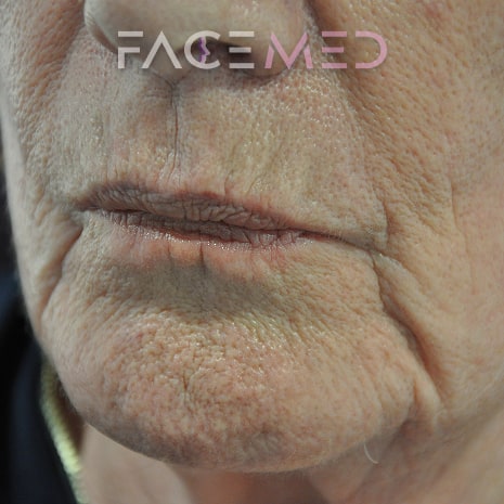 HA dermal filler + muscle relaxant lower face_1_pre