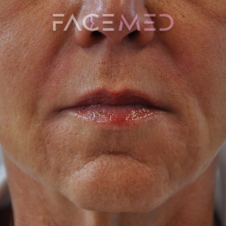 HA dermal filler + muscle relaxant lower face_20_post