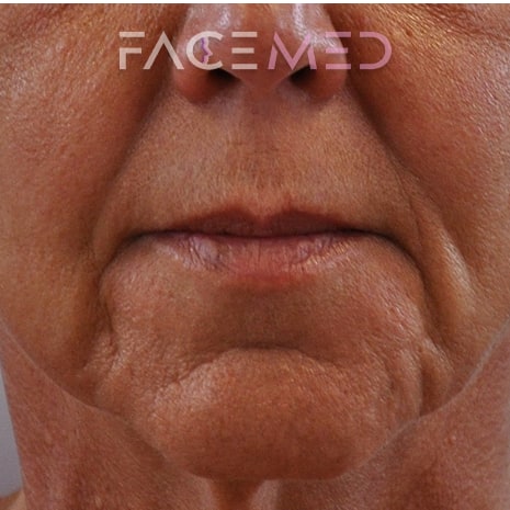 HA dermal filler + muscle relaxant lower face_20_pre