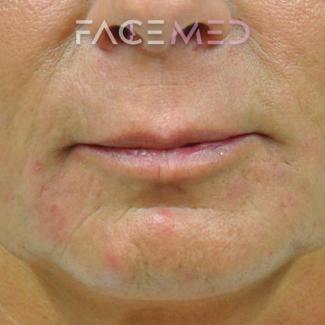 HA dermal filler + muscle relaxant lower face_2_post
