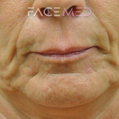 HA dermal filler + muscle relaxant lower face_2_pre