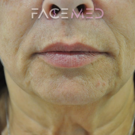 HA dermal filler + muscle relaxant lower face_3_post