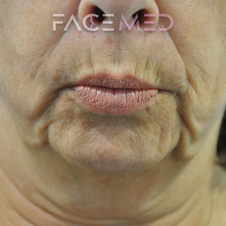 HA dermal filler + muscle relaxant lower face_3_pre