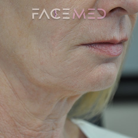 HA dermal filler + muscle relaxant lower face_4_post