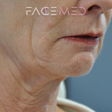 HA dermal filler + muscle relaxant lower face_4_pre