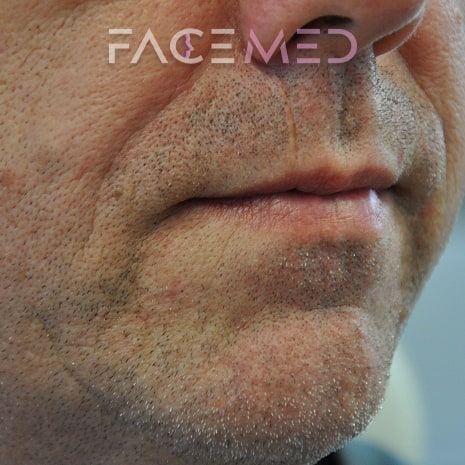 HA dermal filler + muscle relaxant lower face_5_post
