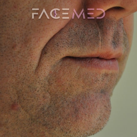HA dermal filler + muscle relaxant lower face_5_pre