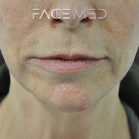 HA dermal filler + muscle relaxant lower face_6_post