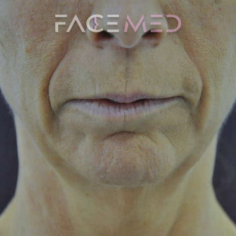 HA dermal filler + muscle relaxant lower face_6_pre