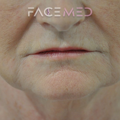 HA dermal filler + muscle relaxant lower face_7_post