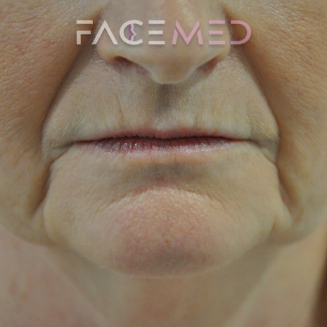 HA dermal filler + muscle relaxant lower face_7_pre