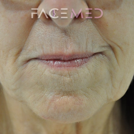 HA dermal filler + muscle relaxant lower face_8_post