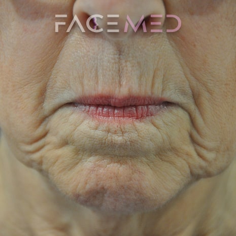 HA dermal filler + muscle relaxant lower face_8_pre