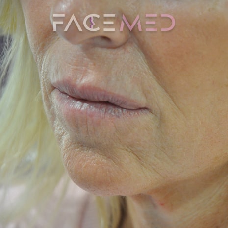 HA dermal filler + muscle relaxant lower face_9_post