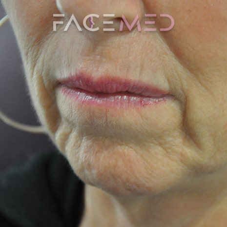 HA dermal filler + muscle relaxant lower face_9_pre