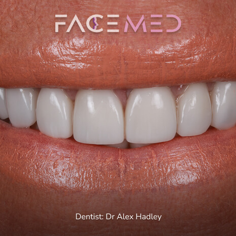 Porcelain Veneers after