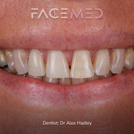 Porcelain Veneers before