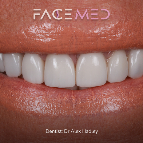 Porcelain Veneers13