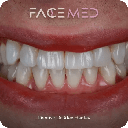Whitening1