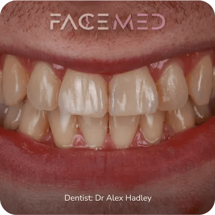 Whitening2
