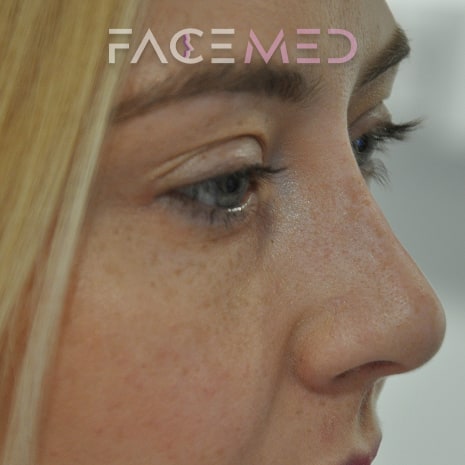 non_surgical_rhinoplasty_post_01