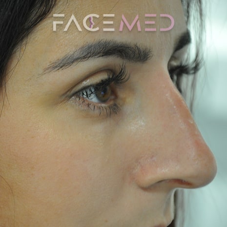 non_surgical_rhinoplasty_post_02