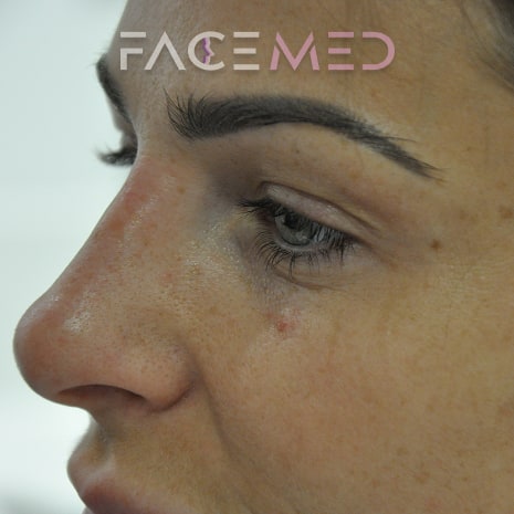 non_surgical_rhinoplasty_post_03