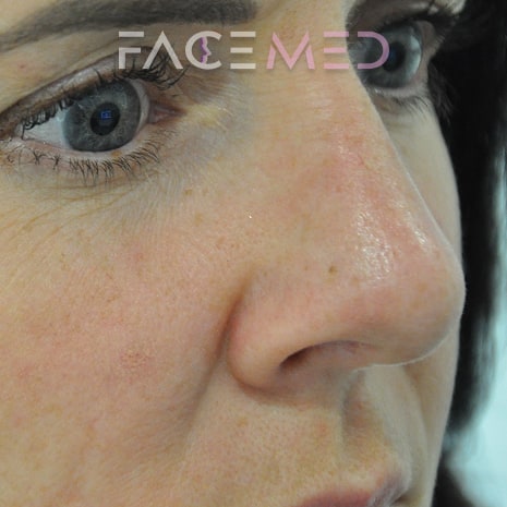 non_surgical_rhinoplasty_post_04
