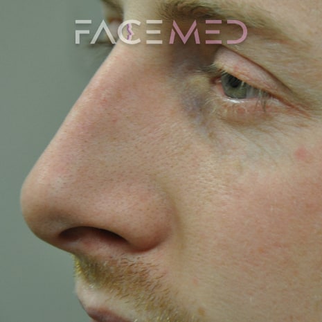 non_surgical_rhinoplasty_post_05