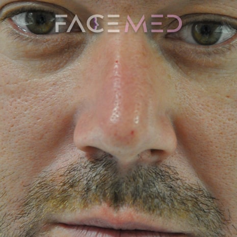 non_surgical_rhinoplasty_post_06