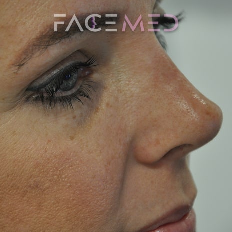 non_surgical_rhinoplasty_post_08